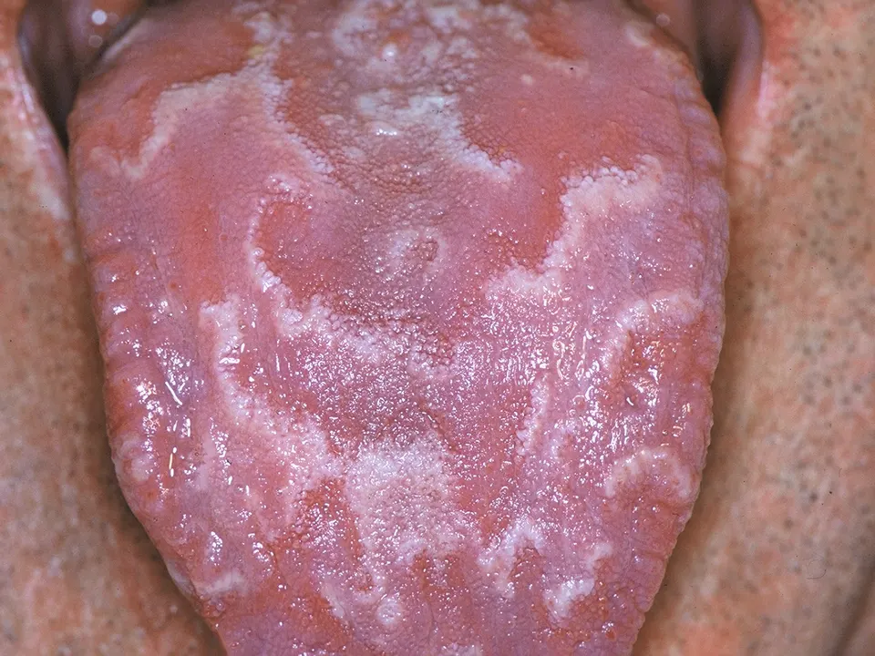 Close-up of a geographic tongue with many red patches and white wavy borders across the whole surface
