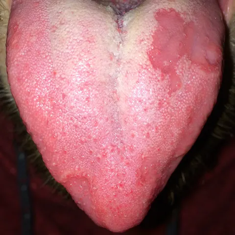 The same tongue two days later: the patch has grown into a larger smooth red area