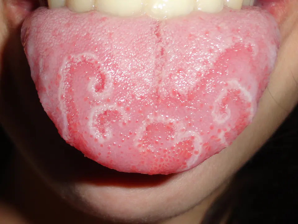 Geographic tongue with smooth red patches outlined by curving white borders on the top of the tongue